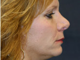 Patient # 41111 After Photo # 2