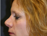 Patient # 41111 After Photo # 4