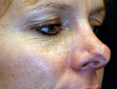 Patient # 41111 Before Photo # 1