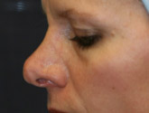 Patient # 41111 Before Photo # 3