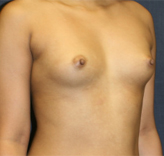 Patient # 17155 Before Photo # 3