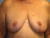 Patient # 32319 After Photo # 2