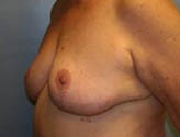 Patient # 32319 After Photo # 4