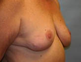Patient # 32319 After Photo # 6