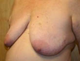Patient # 32319 Before Photo # 3