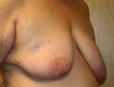 Patient # 32319 Before Photo # 5