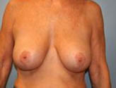 Patient # 27300 After Photo # 2