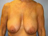Patient # 27300 Before Photo # 1