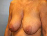 Patient # 27300 Before Photo # 3