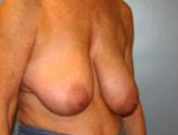 Patient # 27300 Before Photo # 5