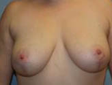 Patient # 37421 After Photo # 2