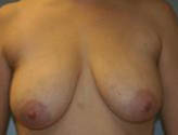 Patient # 37421 Before Photo # 1
