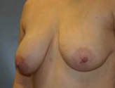 Patient # 37421 Before Photo # 3