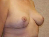 Patient # 55435 After Photo # 4