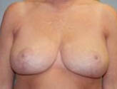 Patient # 91975 After Photo # 2