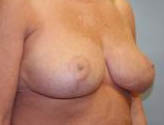 Patient # 91975 After Photo # 4