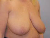 Patient # 91975 Before Photo # 3