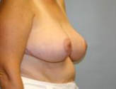 Patient # 75585 After Photo # 4