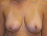 Patient # 61142 After Photo # 2