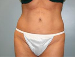 Patient # 15954 After Photo # 2