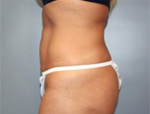 Patient # 15954 After Photo # 4
