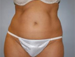 Patient # 15954 Before Photo # 1