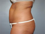 Patient # 15954 Before Photo # 3