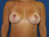 Patient # 19308 After Photo # 2