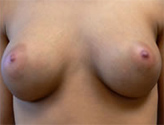 Patient # 26843 After Photo # 2
