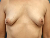 Patient # 36589 Before Photo # 1