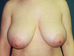 Patient # 96424 Before Photo # 1