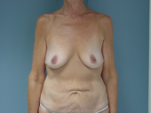 Patient # 76764 Before Photo # 1