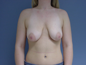 Patient # 72539 Before Photo # 1