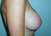 Patient # 23126 After Photo # 2
