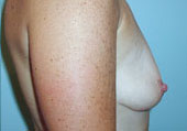 Patient # 23126 Before Photo # 1