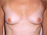 Patient # 18723 Before Photo # 1