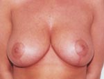 Patient # 27584 After Photo # 2