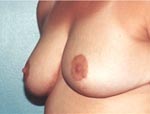 Patient # 22703 After Photo # 4