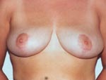 Patient # 27056 After Photo # 2