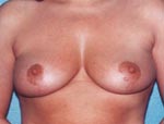 Patient # 50384 After Photo # 2
