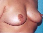 Patient # 50384 After Photo # 4