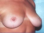 Patient # 44098 After Photo # 4