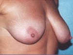 Patient # 44098 Before Photo # 3