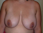 Patient # 71062 Before Photo # 1