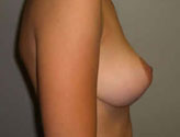 Patient # 55056 After Photo # 4