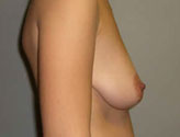 Patient # 55056 Before Photo # 3