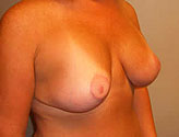 Patient # 85392 After Photo # 2