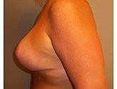 Patient # 85392 After Photo # 4