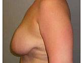 Patient # 85392 Before Photo # 3