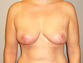 Patient # 40202 After Photo # 2